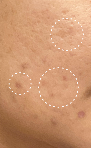Close-up of skin with three circled moles.