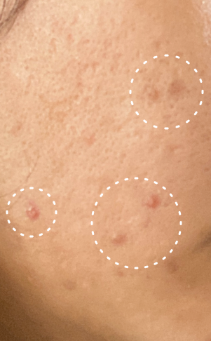 Close-up of skin with blemishes circled, possibly for inspection or educational purposes.